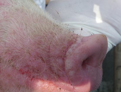 cerdo hocico vesicula no rota de 1 día