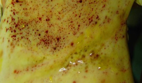 Petequias en mucosa gástrica, intestinal, etc